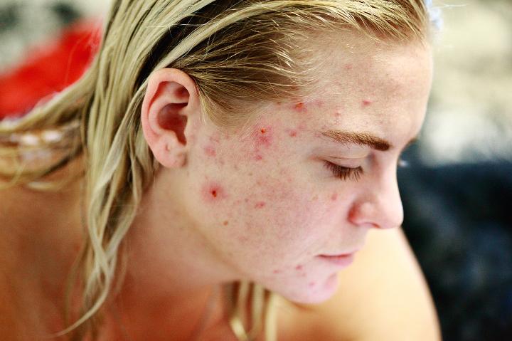 Whey Protein and Acne: Is There a Link?